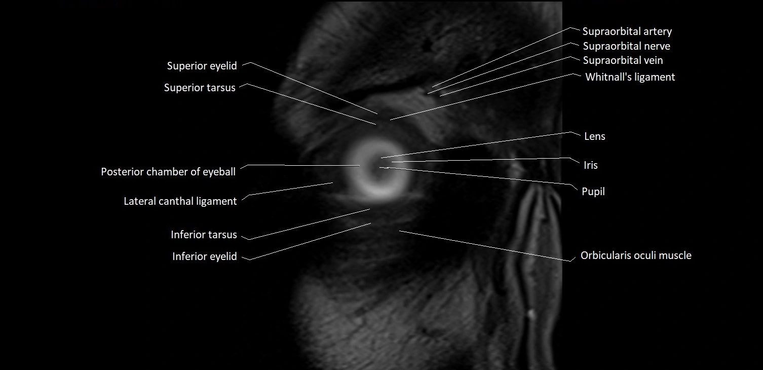 MRI Orbit coronal cross sectional anatomy image 2.webp